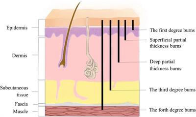 Research advances in prevention and treatment of burn wound deepening in early stage